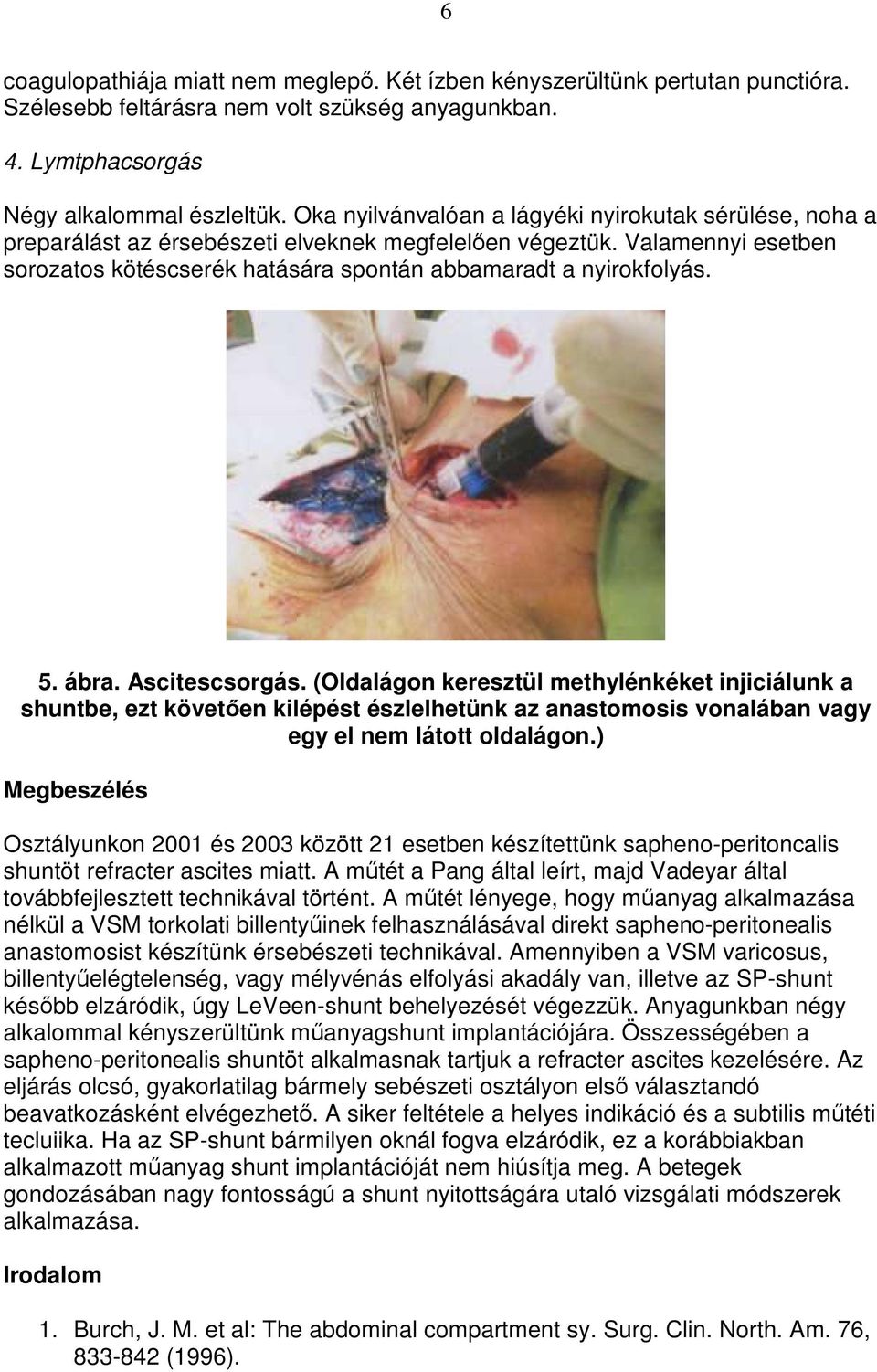 5. ábra. Ascitescsorgás. (Oldalágon keresztül methylénkéket injiciálunk a shuntbe, ezt követıen kilépést észlelhetünk az anastomosis vonalában vagy egy el nem látott oldalágon.