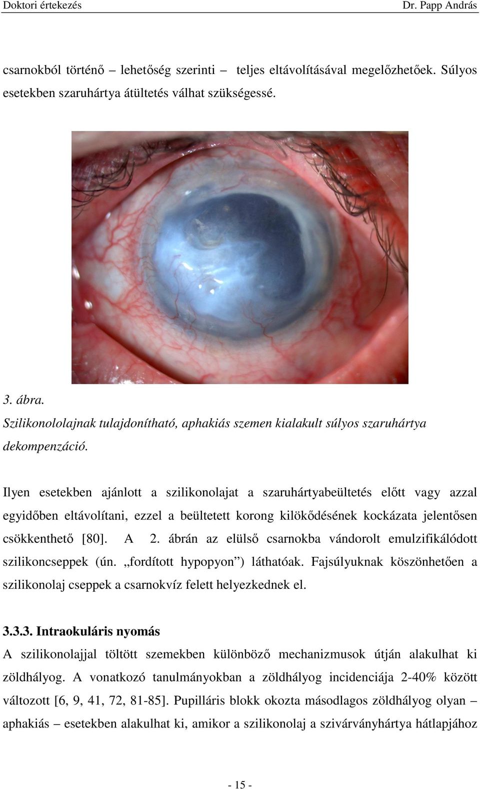 Vitrectomia