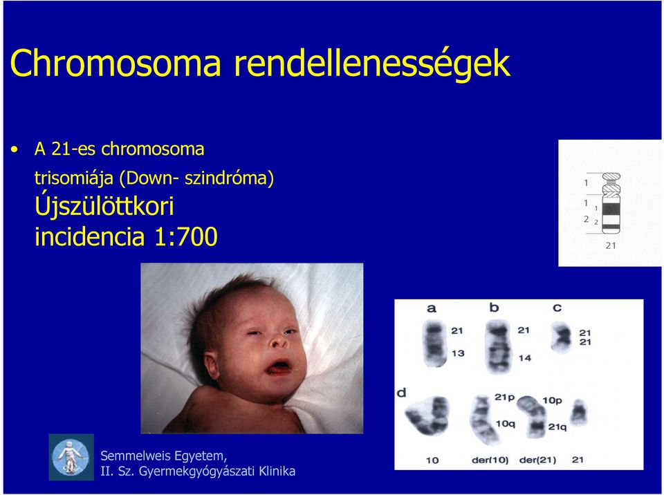 chromosoma trisomiája