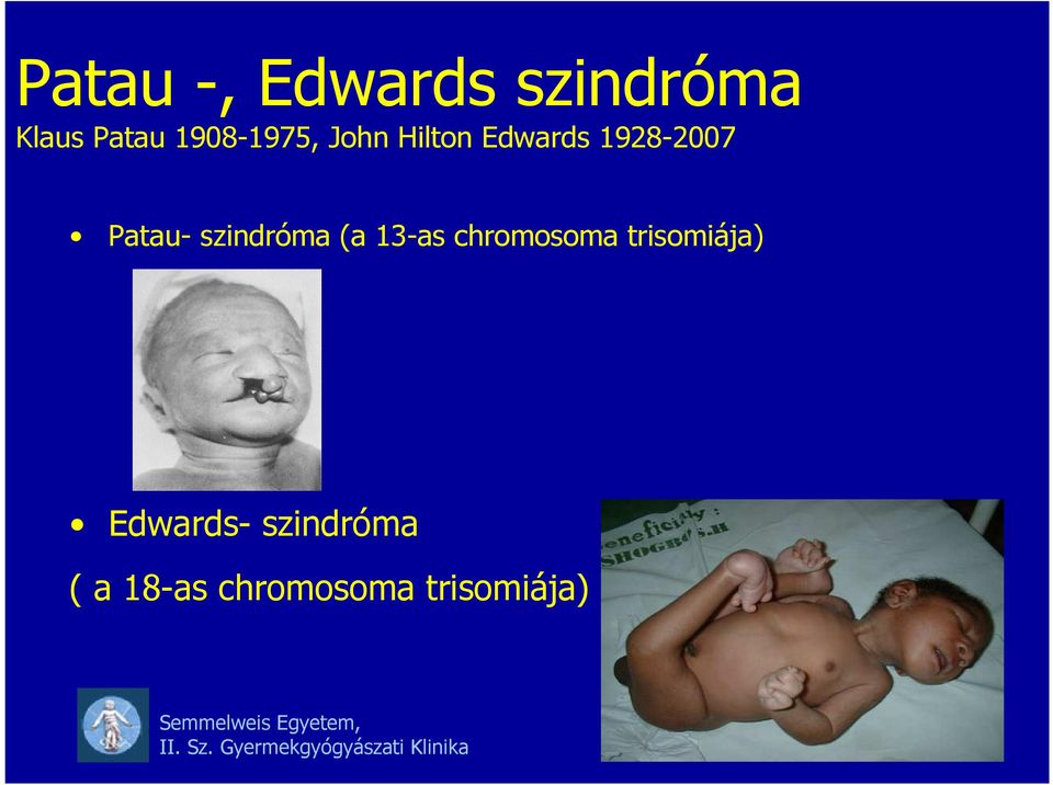 Patau- szindróma (a 13-as chromosoma