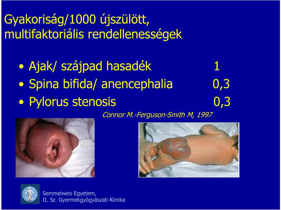 szájpad hasadék 1 Spina bifida/