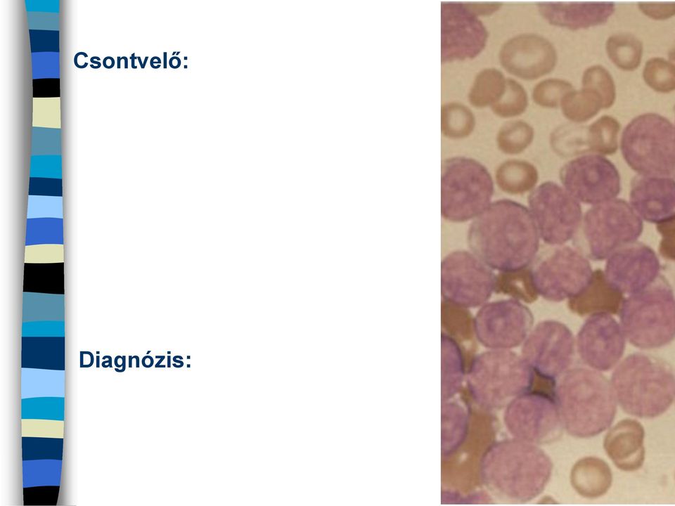 cytometria: CD3+CD7+CD4+CD8+: 65%