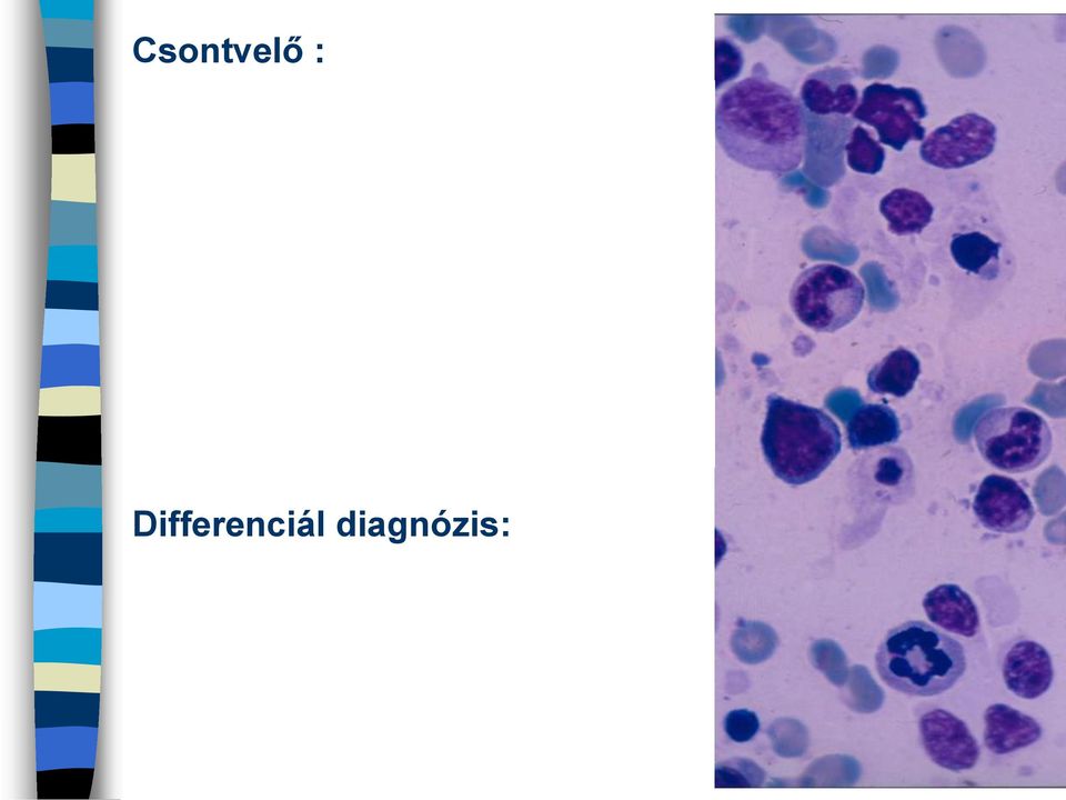 mononuclearis sejt Áramlási cytometria : CD34+: 0%, CD19+CD10+: 0%,
