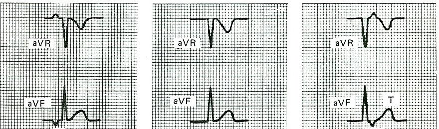 3. A QRS komplex keskeny marad mindaddig, amíg az intraventrikuláris vezetés