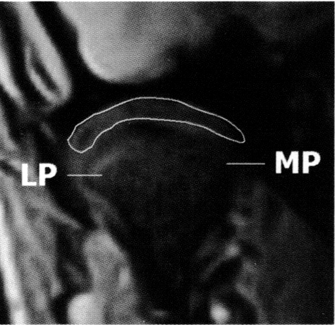 Szagittális metszet Frontális metszet American Journal of Orthodontics an Dentofacial