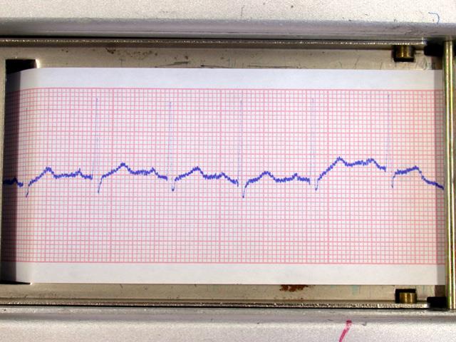 Az elektrokardiogram, EKG szinuszcsomó AV csomó R P T Q S 0,18 s