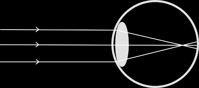3/B feladat Megoldás: a) Milyen látásproblémával küzd, és milyen okok állhatnak ennek a látásproblémának a hátterében? A látásprobléma neve rövidlátás (miópia; elegendő az egyik megnevezés).