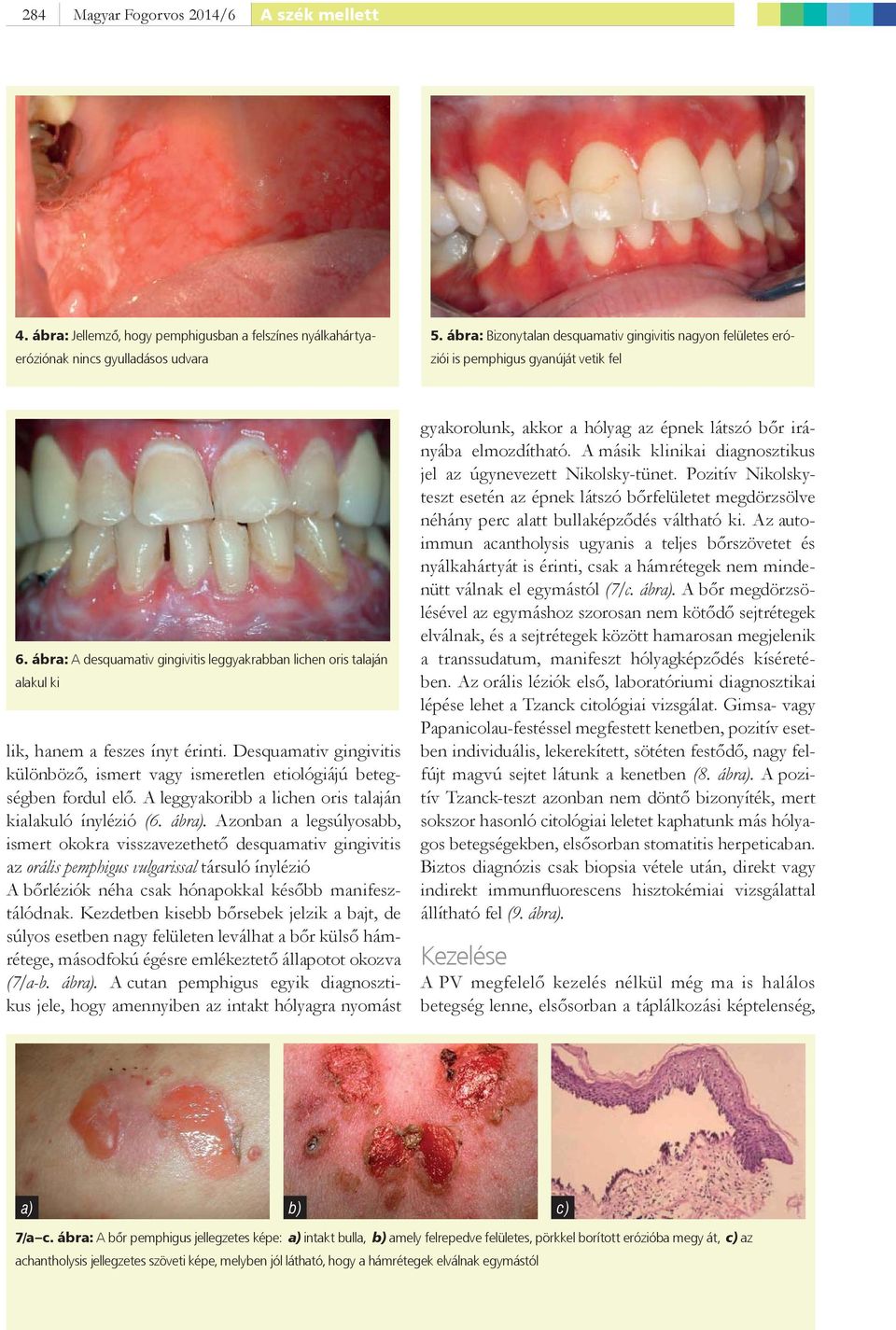 ábra: A desquamativ gingivitis leggyakrabban lichen oris talaján alakul ki lik, hanem a feszes ínyt érinti. Desquamativ gingivitis különböző, ismert vagy ismeretlen etiológiájú betegségben fordul elő.