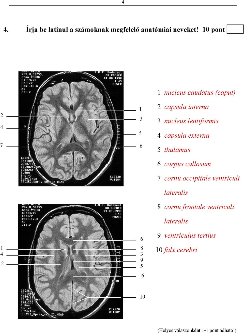 4 capsula externa 4 7 6 5 thalamus 6 corpus callosum 7 cornu occipitale ventriculi