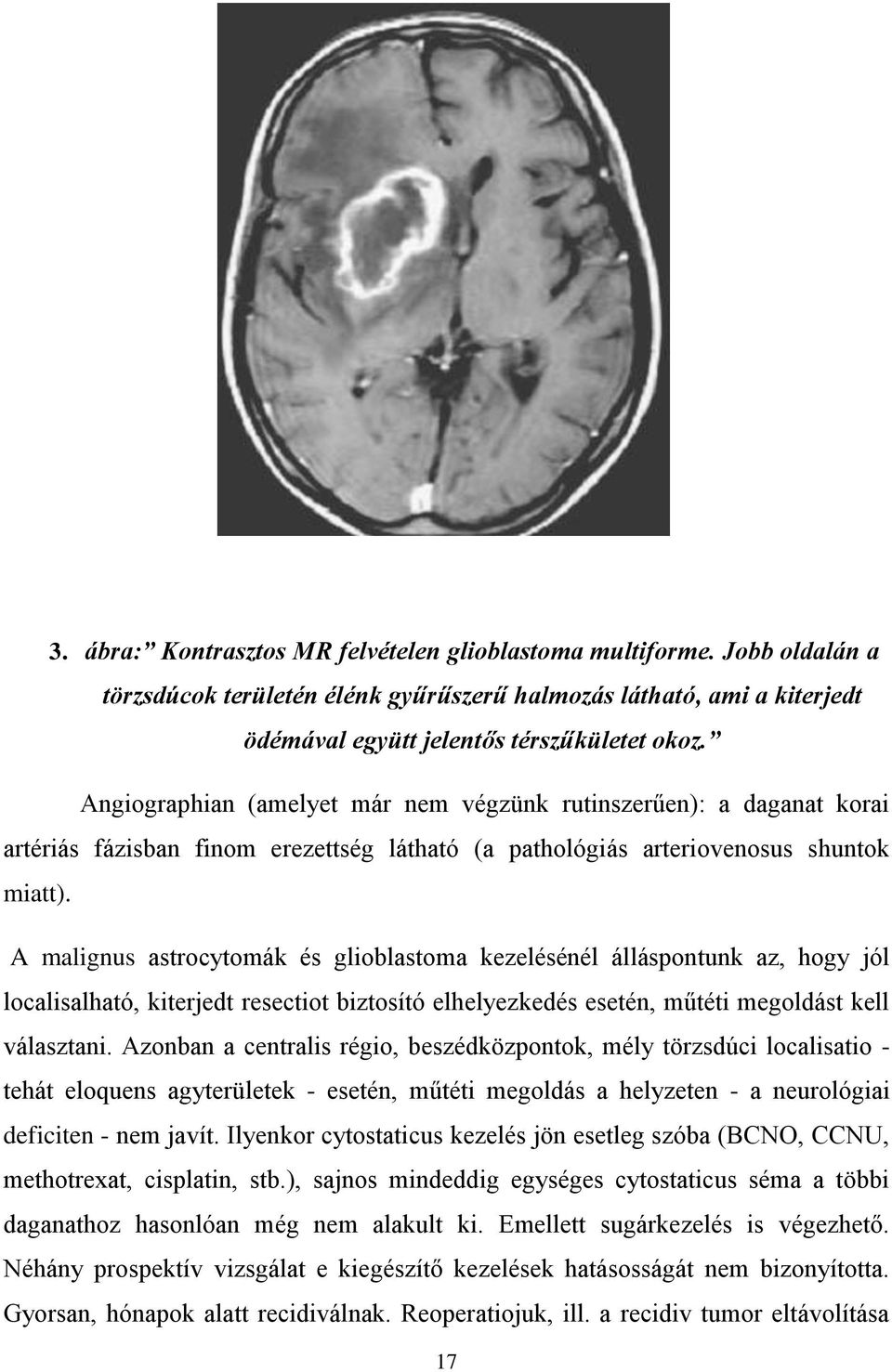 A malignus astrocytomák és glioblastoma kezelésénél álláspontunk az, hogy jól localisalható, kiterjedt resectiot biztosító elhelyezkedés esetén, műtéti megoldást kell választani.