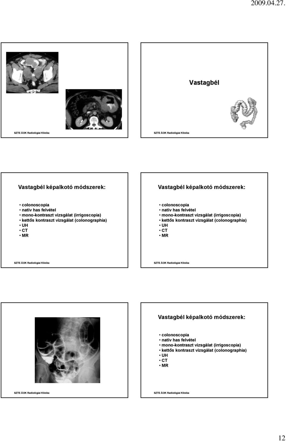 felvétel mono-kontraszt vizsgálat (irrigoscopia) kettős kontraszt vizsgálat (colonographia) UH Vastagbél képalkotó