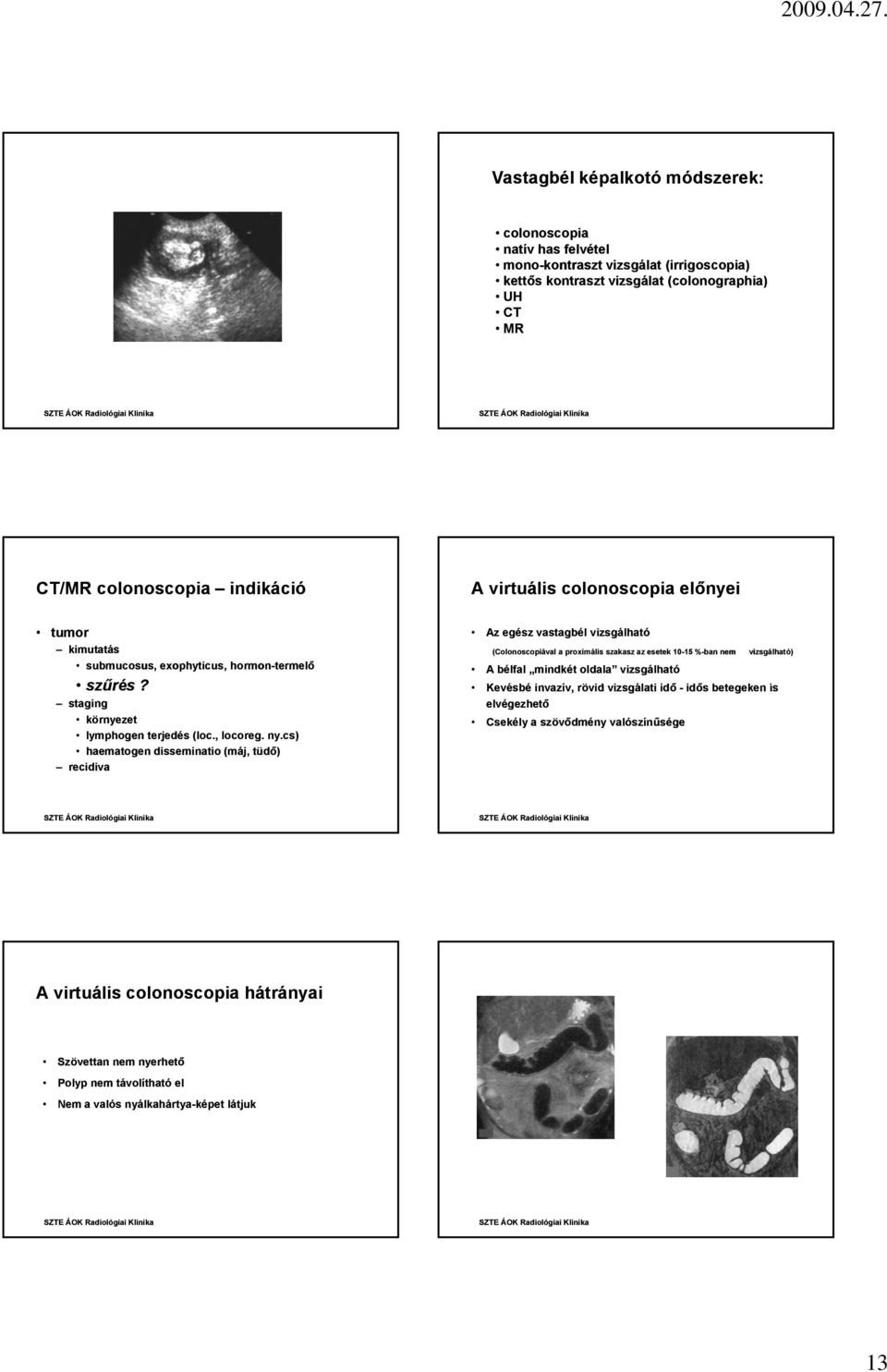 cs) haematogen disseminatio (máj, tüdő) recidiva Az egész vastagbél vizsgálható (Colonoscopiával a proximális szakasz az esetek 10-1515 %-ban nem A bélfal mindkét oldala vizsgálható