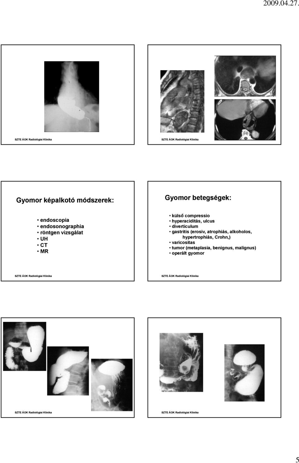 ulcus diverticulum gastritis (erosiv, atrophiás, alkoholos,