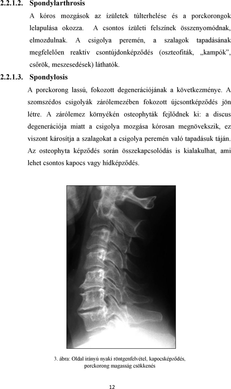 Spondylosis A porckorong lassú, fokozott degenerációjának a következménye. A szomszédos csigolyák zárólemezében fokozott újcsontképződés jön létre.