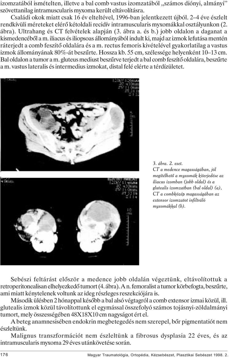 Ultrahang és CT felvételek alapján (3. ábra a. és b.) jobb oldalon a daganat a kismedencébôl a m.