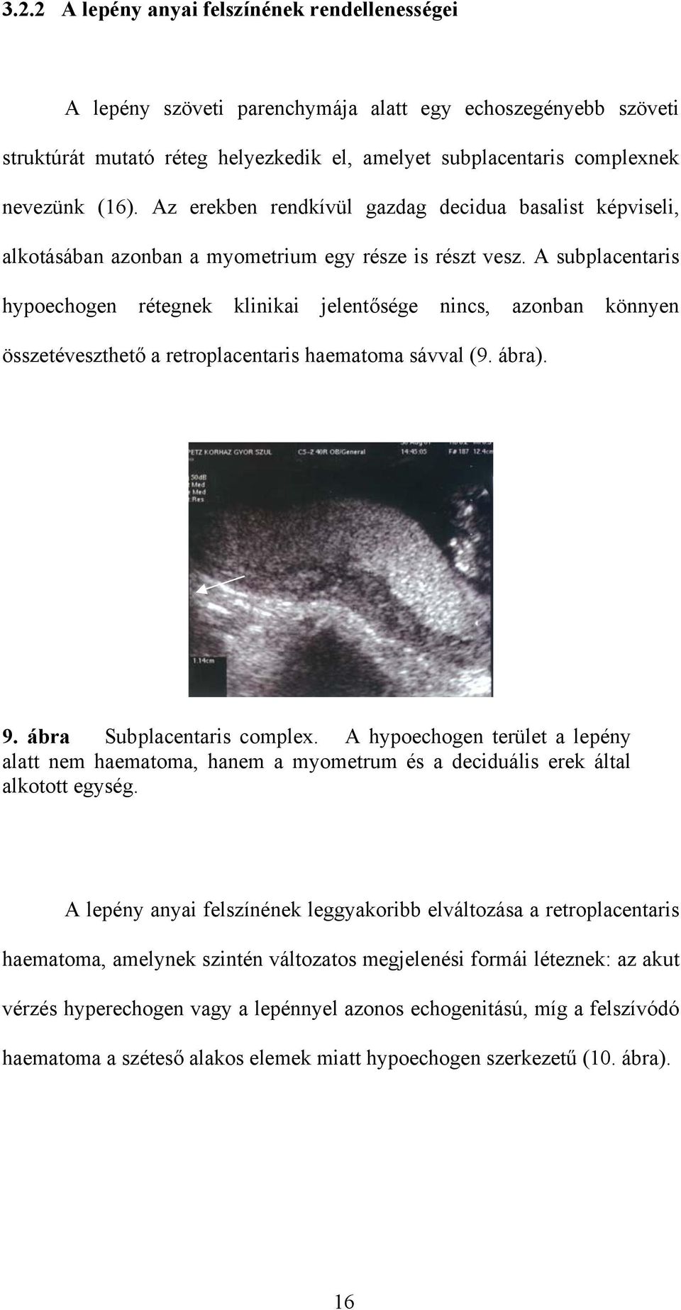 A subplacentaris hypoechogen rétegnek klinikai jelentősége nincs, azonban könnyen összetéveszthető a retroplacentaris haematoma sávval (9. ábra). 9. ábra Subplacentaris complex.
