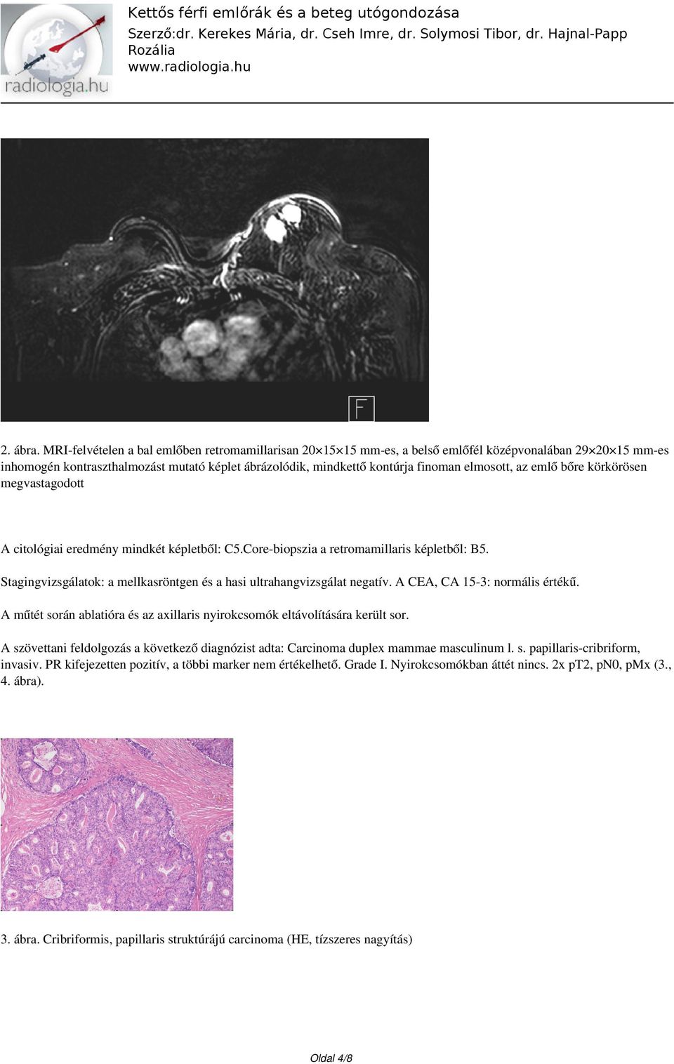 elmosott, az emlő bőre körkörösen megvastagodott A citológiai eredmény mindkét képletből: C5.Core-biopszia a retromamillaris képletből: B5.