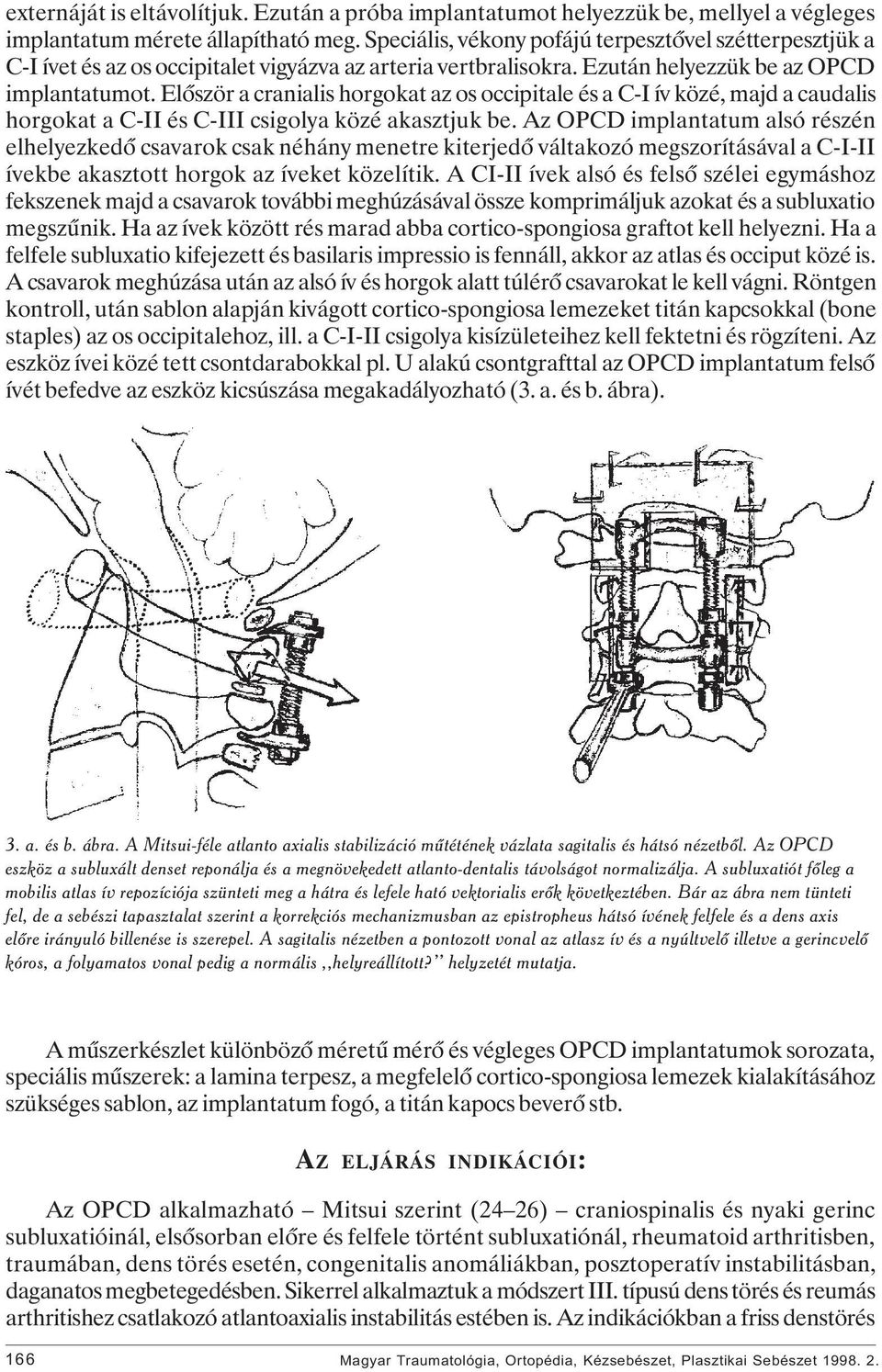 Elôször a cranialis horgokat az os occipitale és a C-I ív közé, majd a caudalis horgokat a C-II és C-III csigolya közé akasztjuk be.