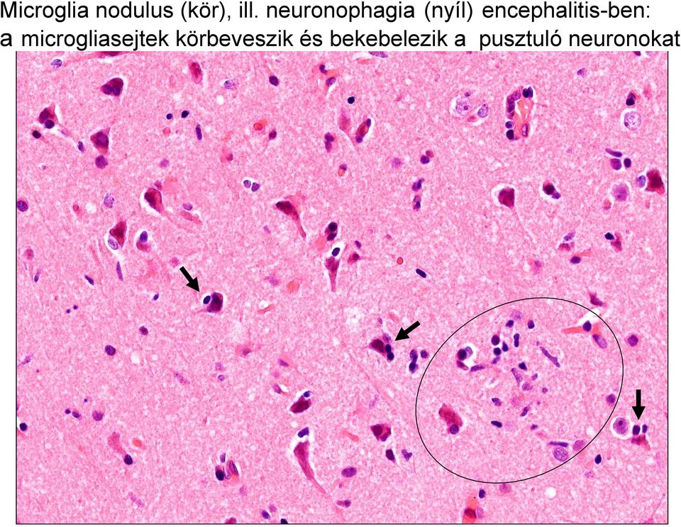 encephalitis-ben: a