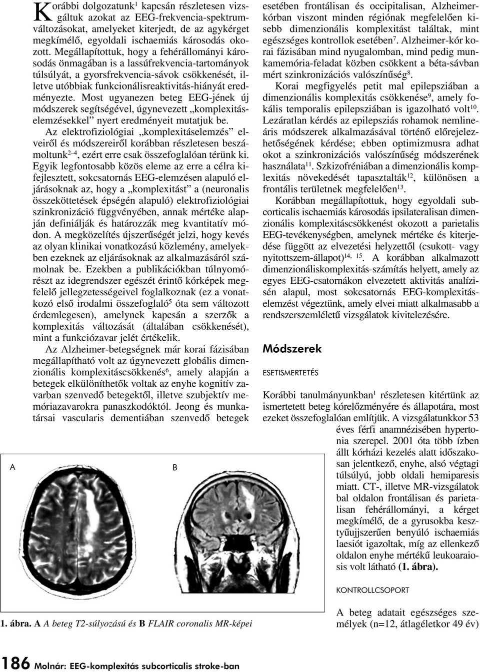eredményezte. Most ugyanezen beteg EEG-jének új módszerek segítségével, úgynevezett komplexitáselemzésekkel nyert eredményeit mutatjuk be.