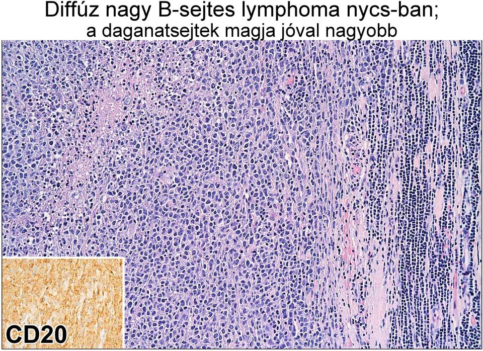 B-sejtes lymphomák. 1. Lassú lefolyás. 2. Gyors, agresszív lefolyás - PDF  Ingyenes letöltés