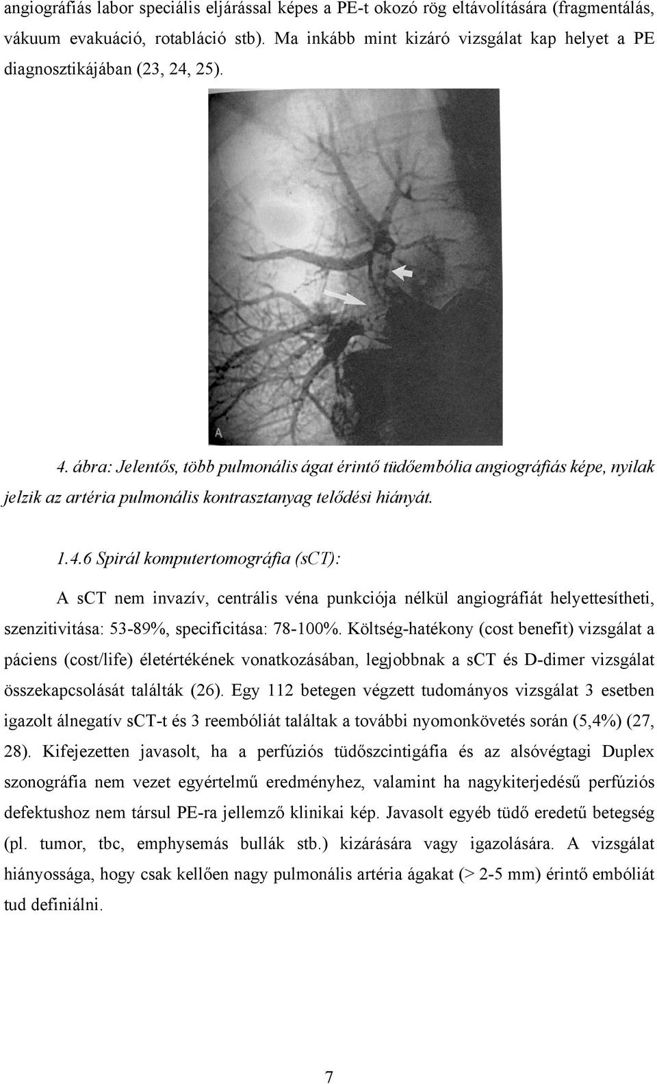 ábra: Jelentős, több pulmonális ágat érintő tüdőembólia angiográfiás képe, nyilak jelzik az artéria pulmonális kontrasztanyag telődési hiányát. 1.4.