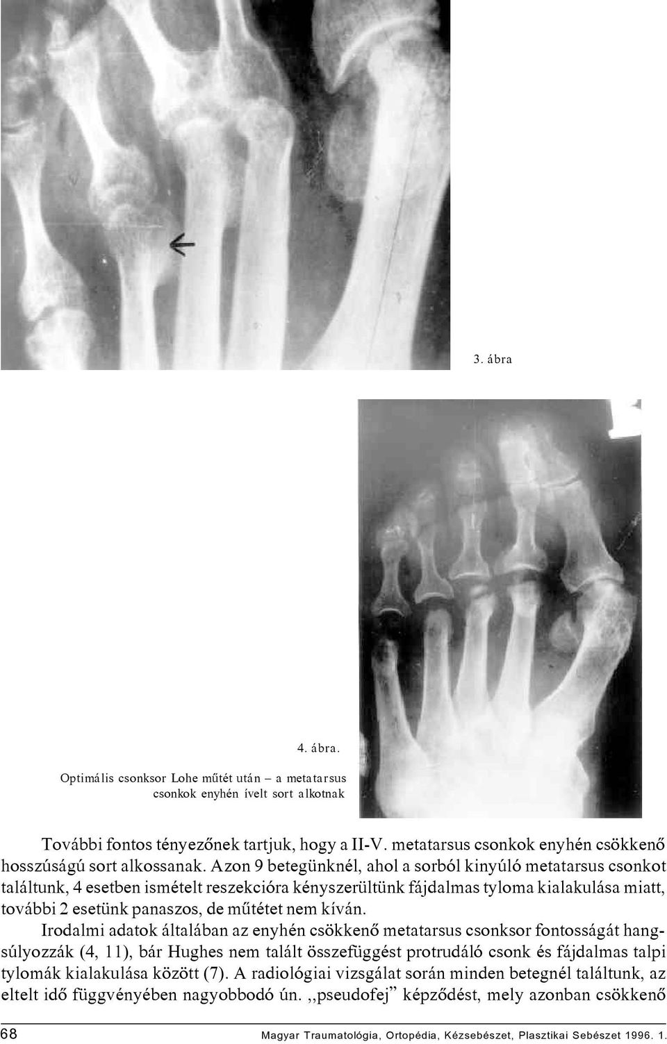 Azon 9 betegünknél, ahol a sorból kinyúló metatarsus csonkot találtunk, 4 esetben ismételt reszekcióra kényszerültünk fájdalmas tyloma kialakulása miatt, további 2 esetünk panaszos, de mûtétet nem