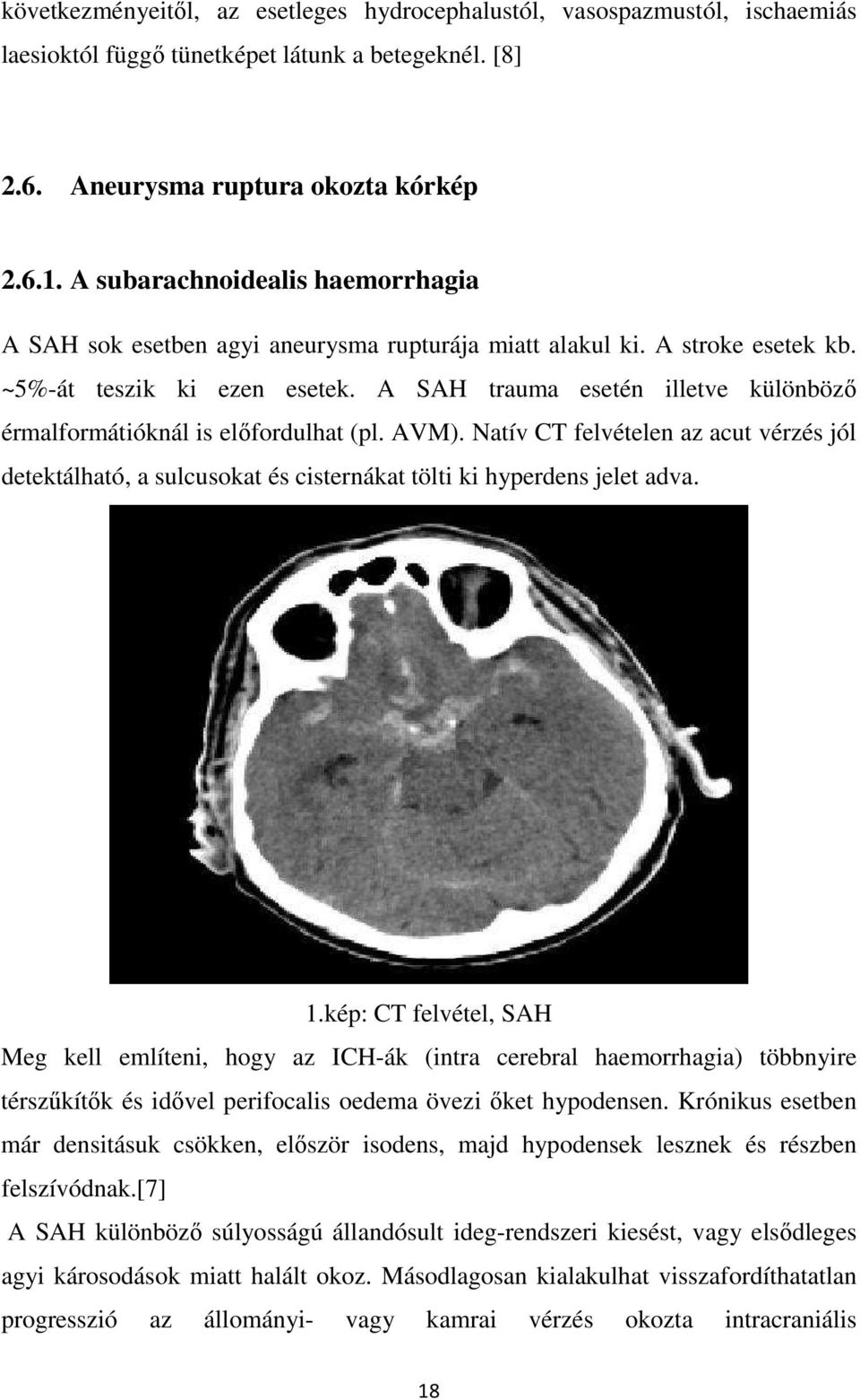 A SAH trauma esetén illetve különböző érmalformátióknál is előfordulhat (pl. AVM). Natív CT felvételen az acut vérzés jól detektálható, a sulcusokat és cisternákat tölti ki hyperdens jelet adva. 1.