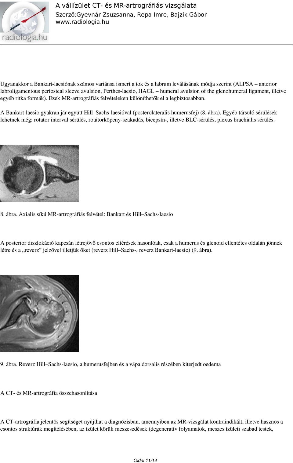 A Bankart-laesio gyakran jár együtt Hill Sachs-laesióval (posterolateralis humerusfej) (8. ábra).