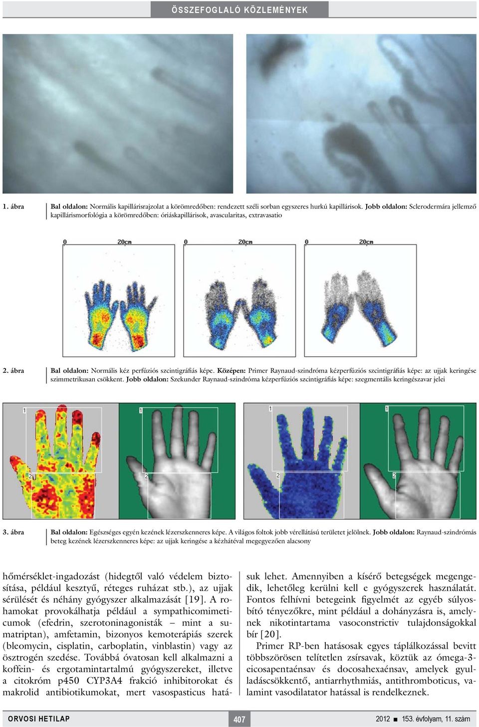 Középen: Primer Raynaud-szindróma kézperfúziós szcintigráfiás képe: az ujjak keringése szimmetrikusan csökkent.