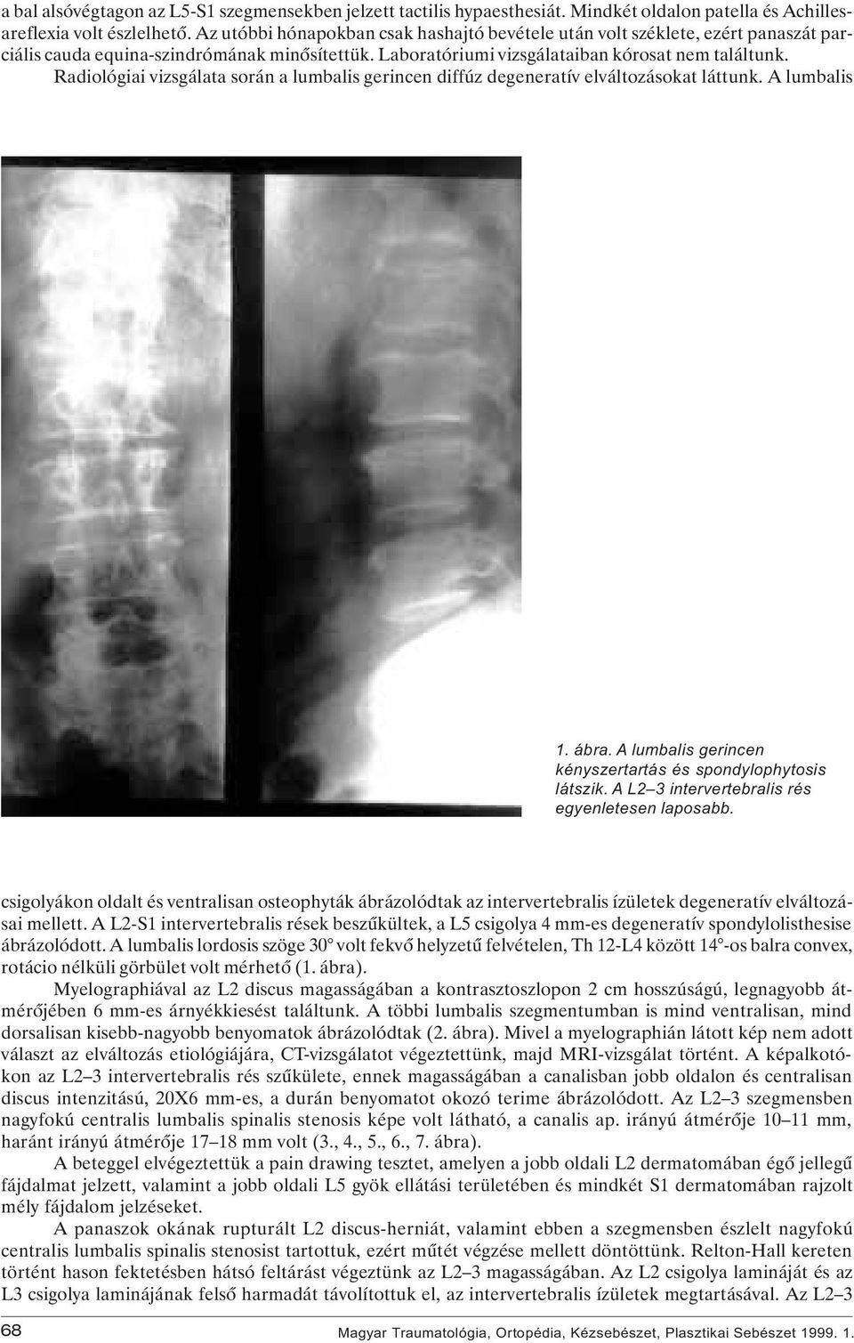 Radiológiai vizsgálata során a lumbalis gerincen diffúz degeneratív elváltozásokat láttunk. A lumbalis 1. ábra. A lumbalis gerincen kényszertartás és spondylophytosis látszik.