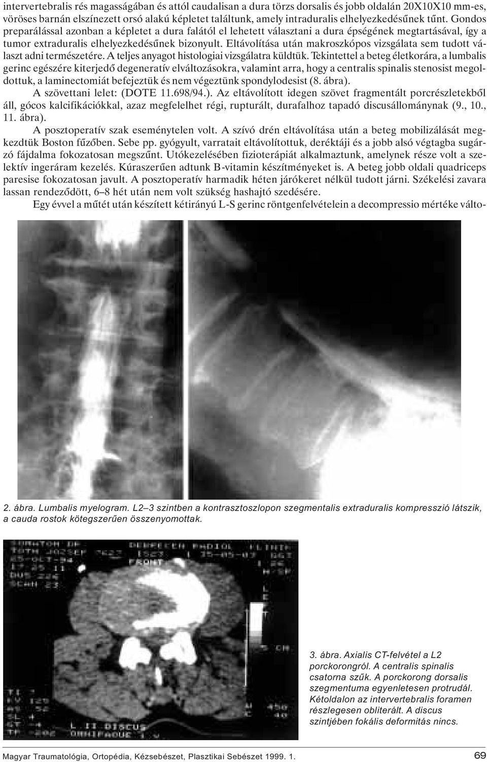 Eltávolítása után makroszkópos vizsgálata sem tudott választ adni természetére. A teljes anyagot histologiai vizsgálatra küldtük.