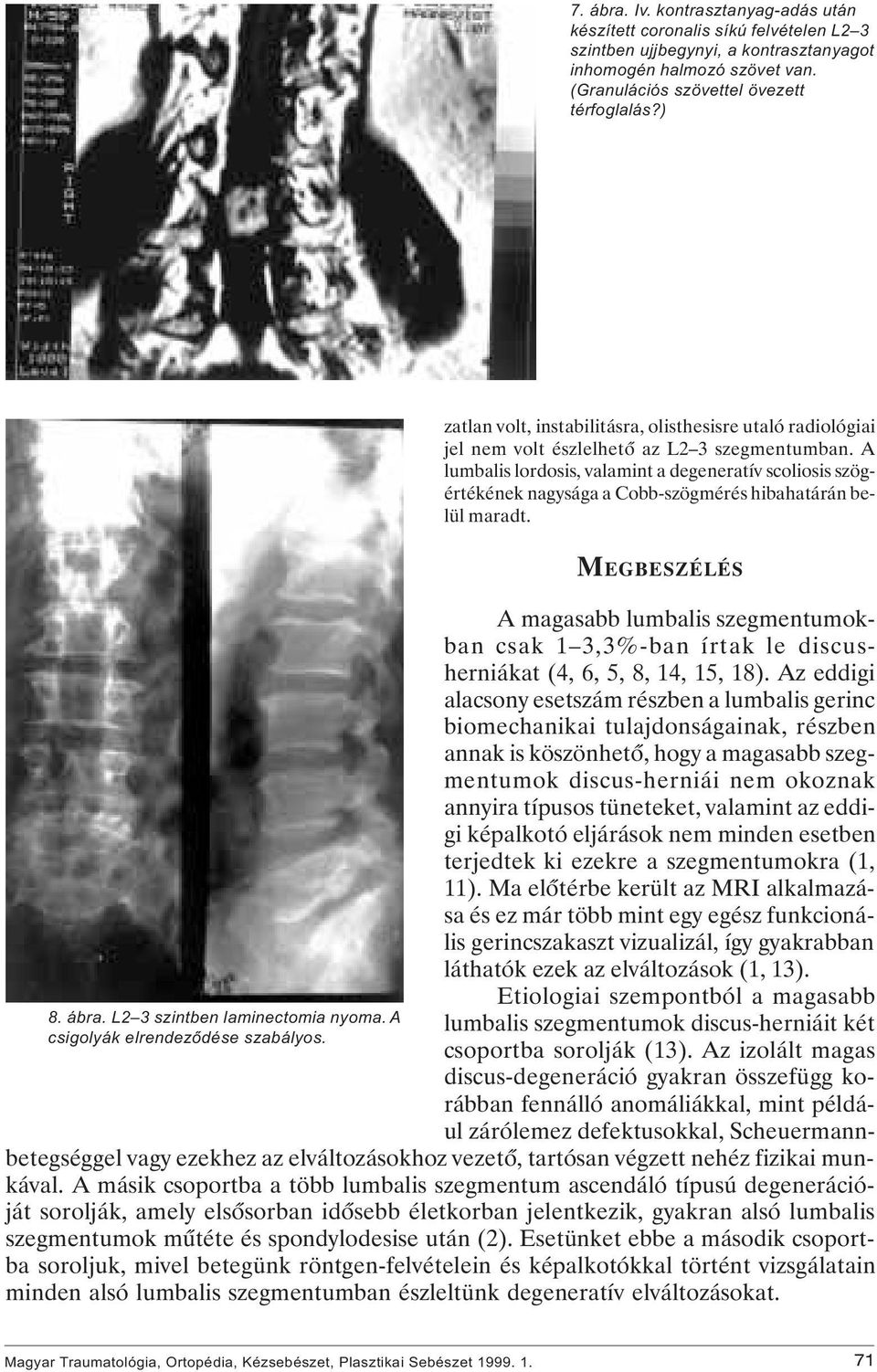 A lumbalis lordosis, valamint a degeneratív scoliosis szögértékének nagysága a Cobb-szögmérés hibahatárán belül maradt. 8. ábra. L2 3 szintben laminectomia nyoma. A csigolyák elrendezôdése szabályos.