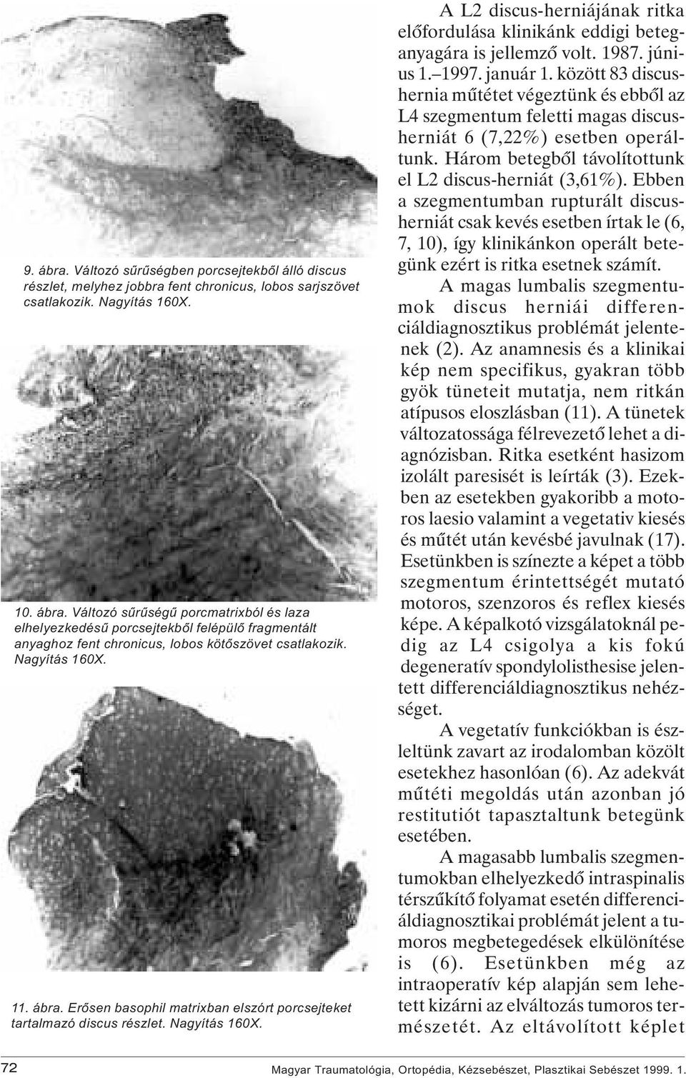 A L2 discus-herniájának ritka elôfordulása klinikánk eddigi beteganyagára is jellemzô volt. 1987. június 1. 1997. január 1.