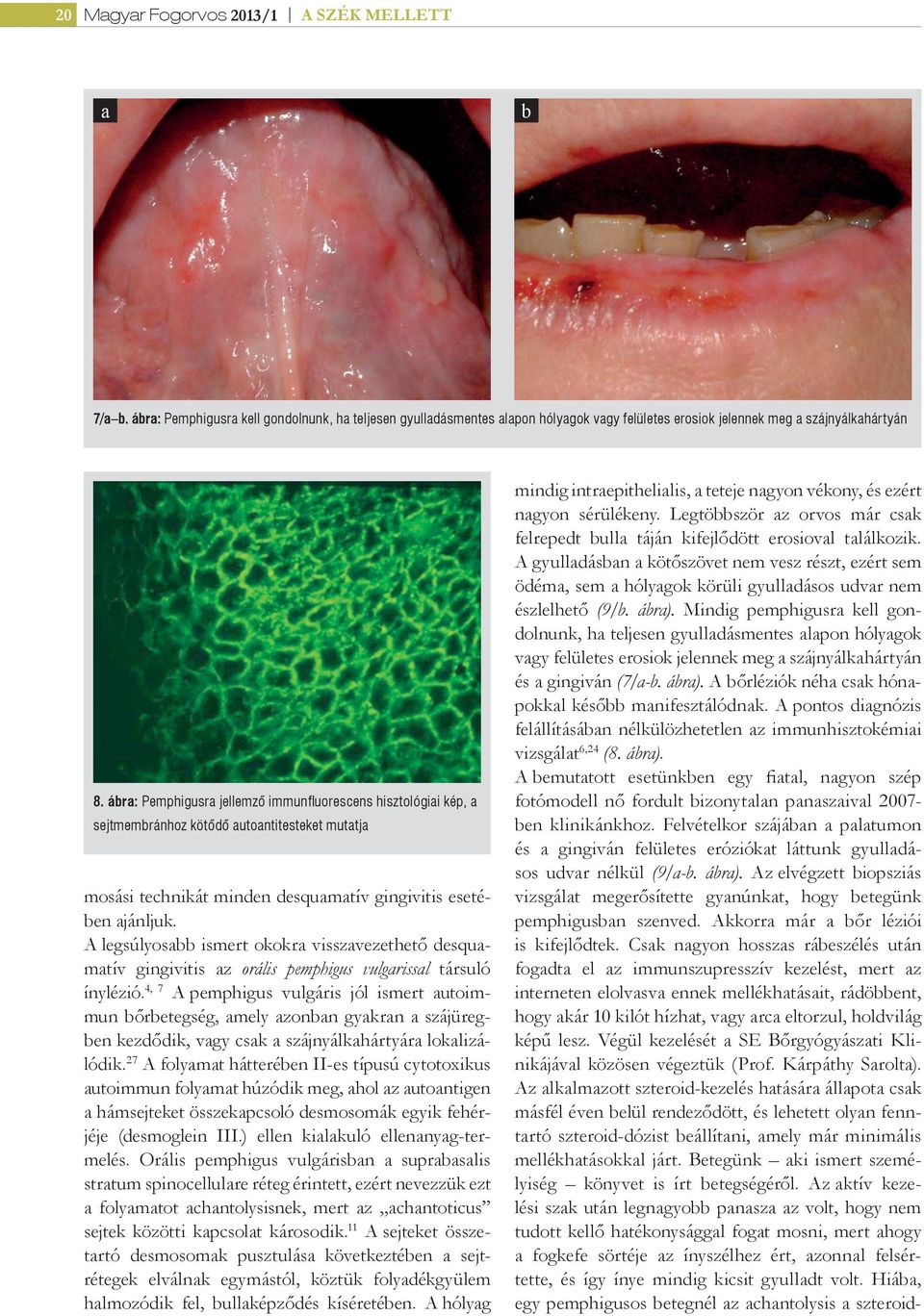 A legsúlyosabb ismert okokra visszavezethető desquamatív gingivitis az orális pemphigus vulgarissal társuló ínylézió.