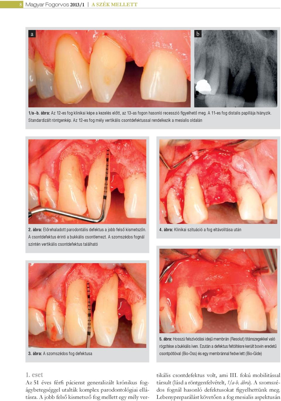 A csontdefektus érinti a bukkális csontlemezt. A szomszédos fognál szintén vertikális csontdefektus található 4. ábra: Klinikai szituáció a fog eltávolítása után 3. ábra: A szomszédos fog defektusa 5.