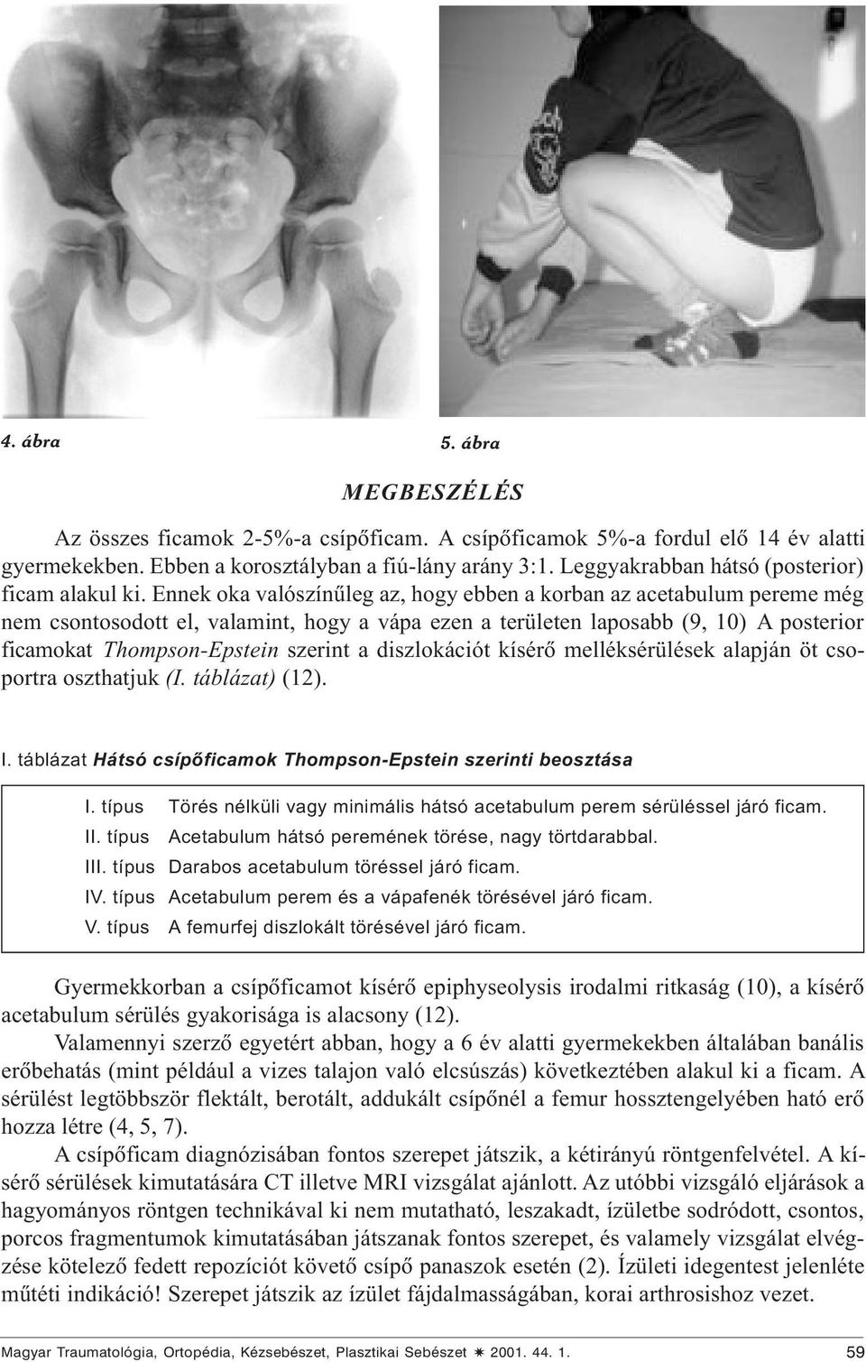 Ennek oka valószínûleg az, hogy ebben a korban az acetabulum pereme még nem csontosodott el, valamint, hogy a vápa ezen a területen laposabb (9, 10) A posterior ficamokat Thompson-Epstein szerint a