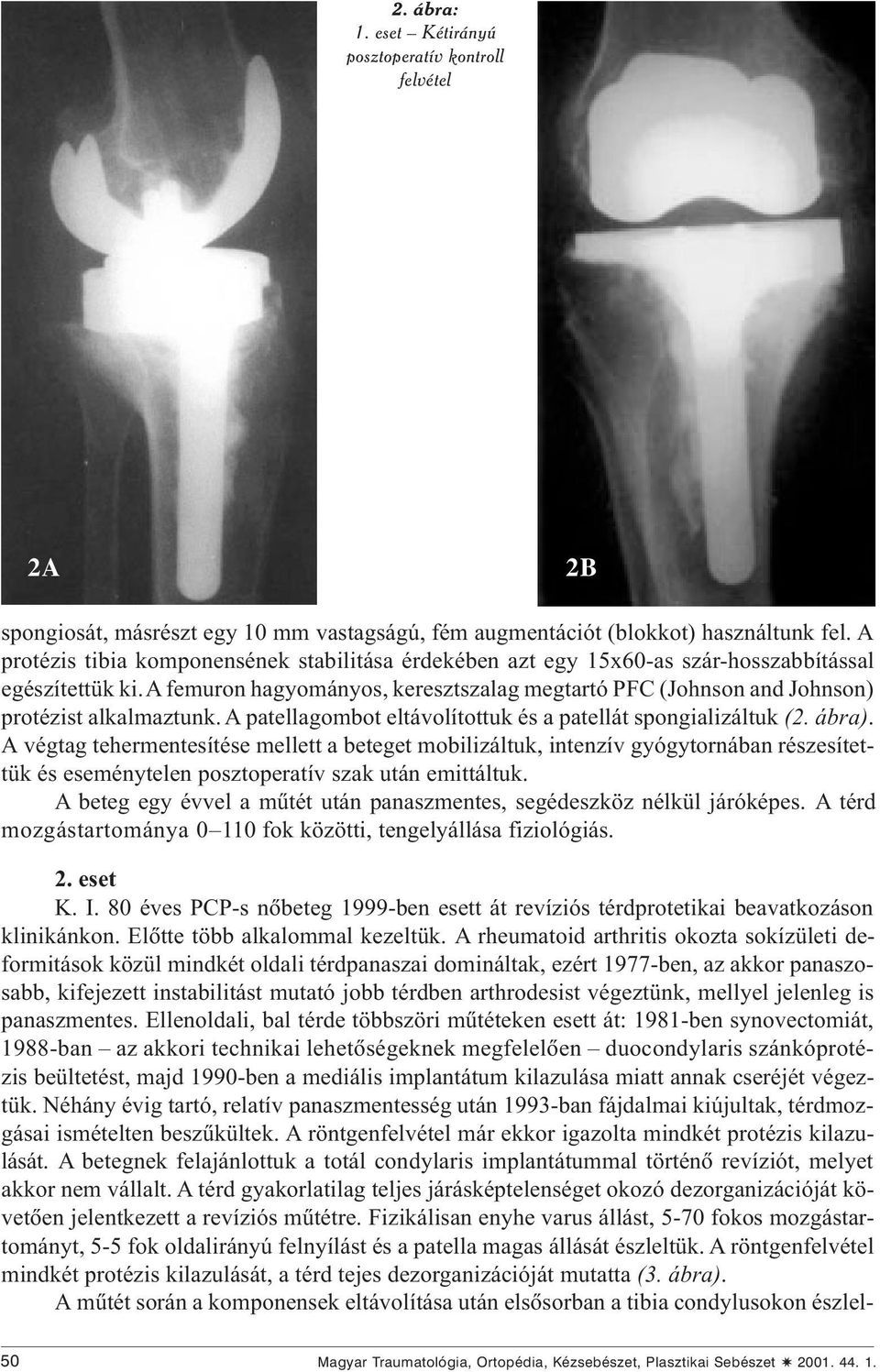 a femuron hagyományos, keresztszalag megtartó PFC (Johnson and Johnson) protézist alkalmaztunk. A patellagombot eltávolítottuk és a patellát spongializáltuk (2. ábra).