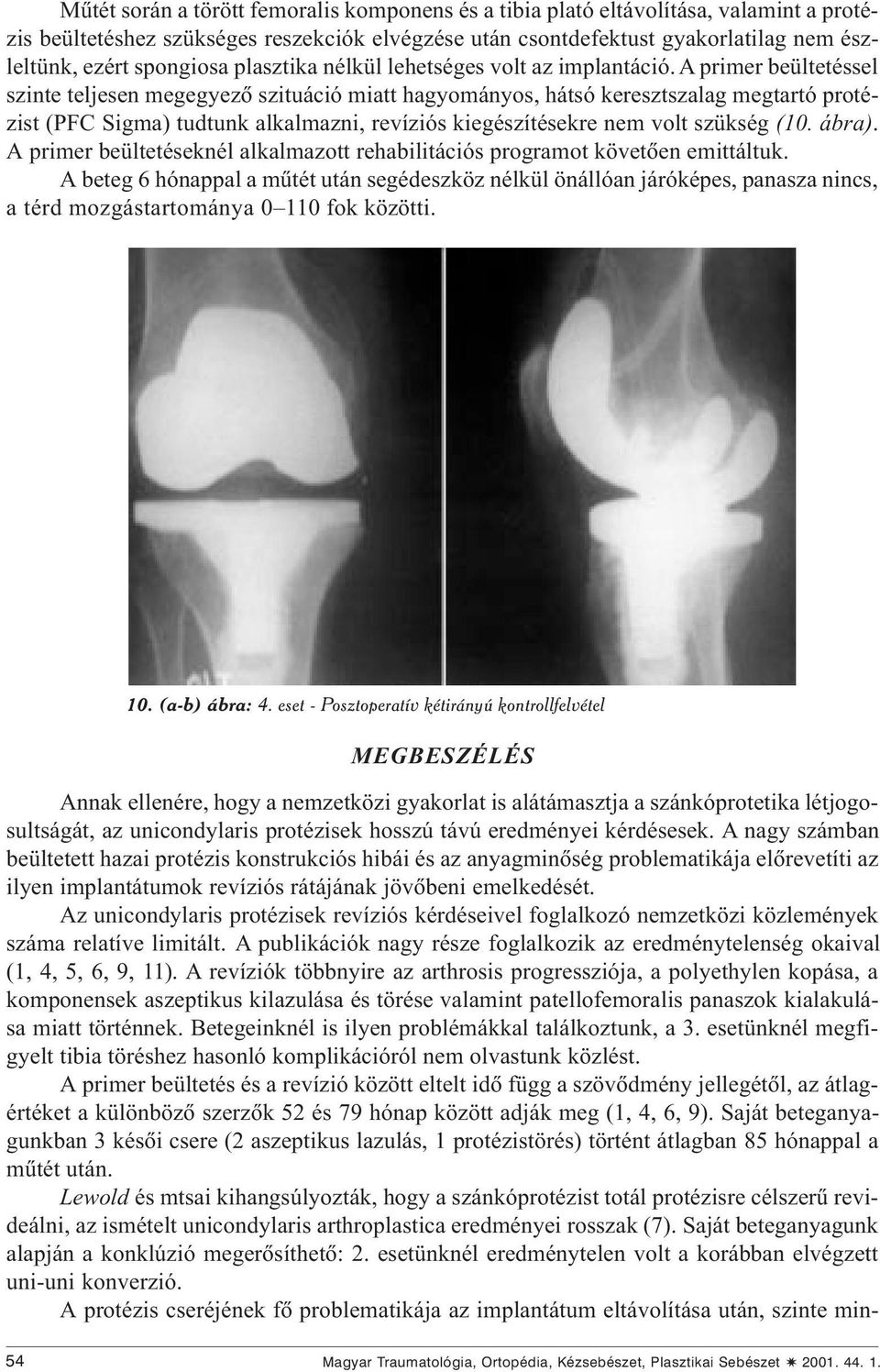 A primer beültetéssel szinte teljesen megegyezõ szituáció miatt hagyományos, hátsó keresztszalag megtartó protézist (PFC Sigma) tudtunk alkalmazni, revíziós kiegészítésekre nem volt szükség (10.