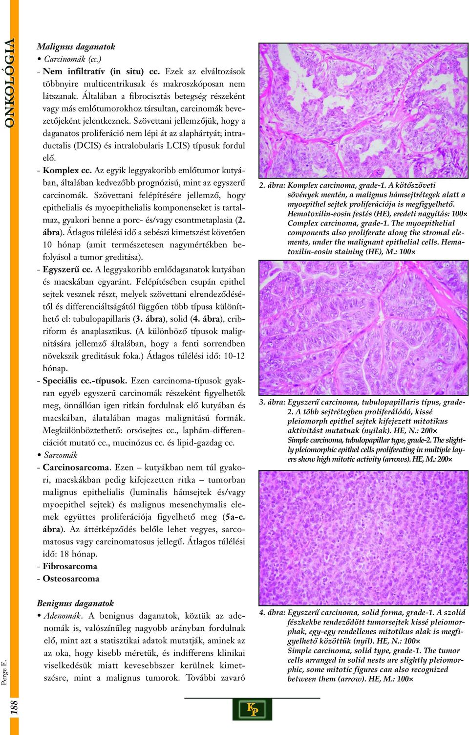 Szövettani jellemzôjük, hogy a daganatos proliferáció nem lépi át az alaphártyát; intraductalis (DCIS) és intralobularis LCIS) típusuk fordul elô. - Komplex cc.