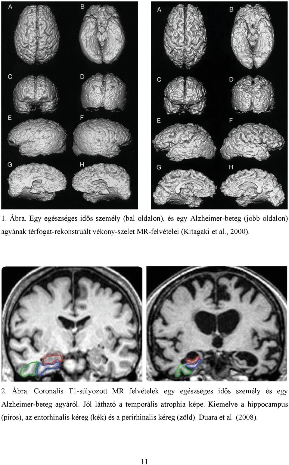 térfogat-rekonstruált vékony-szelet MR-felvételei (Kitagaki et al., 2000). 2. Ábra.