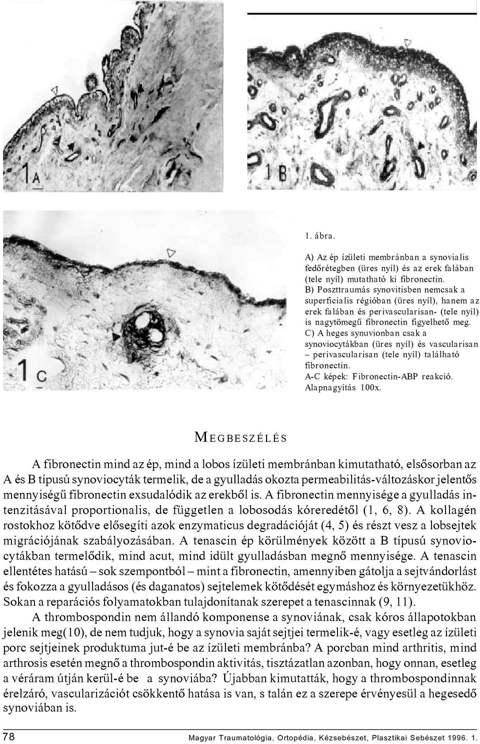 C) A heges synuvionban csak a synoviocytákban (üres nyíl) és vascularisan perivascularisan (tele nyíl) található fibronectin. A-C képek: Fibronectin-ABP reakció. Alapnagyítás 100x.