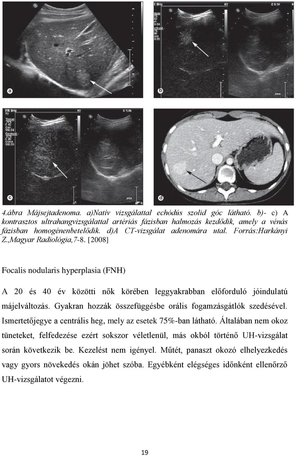 [2008] Focalis nodularis hyperplasia (FNH) A 20 és 40 év közötti nők körében leggyakrabban előforduló jóindulatú májelváltozás. Gyakran hozzák összefüggésbe orális fogamzásgátlók szedésével.