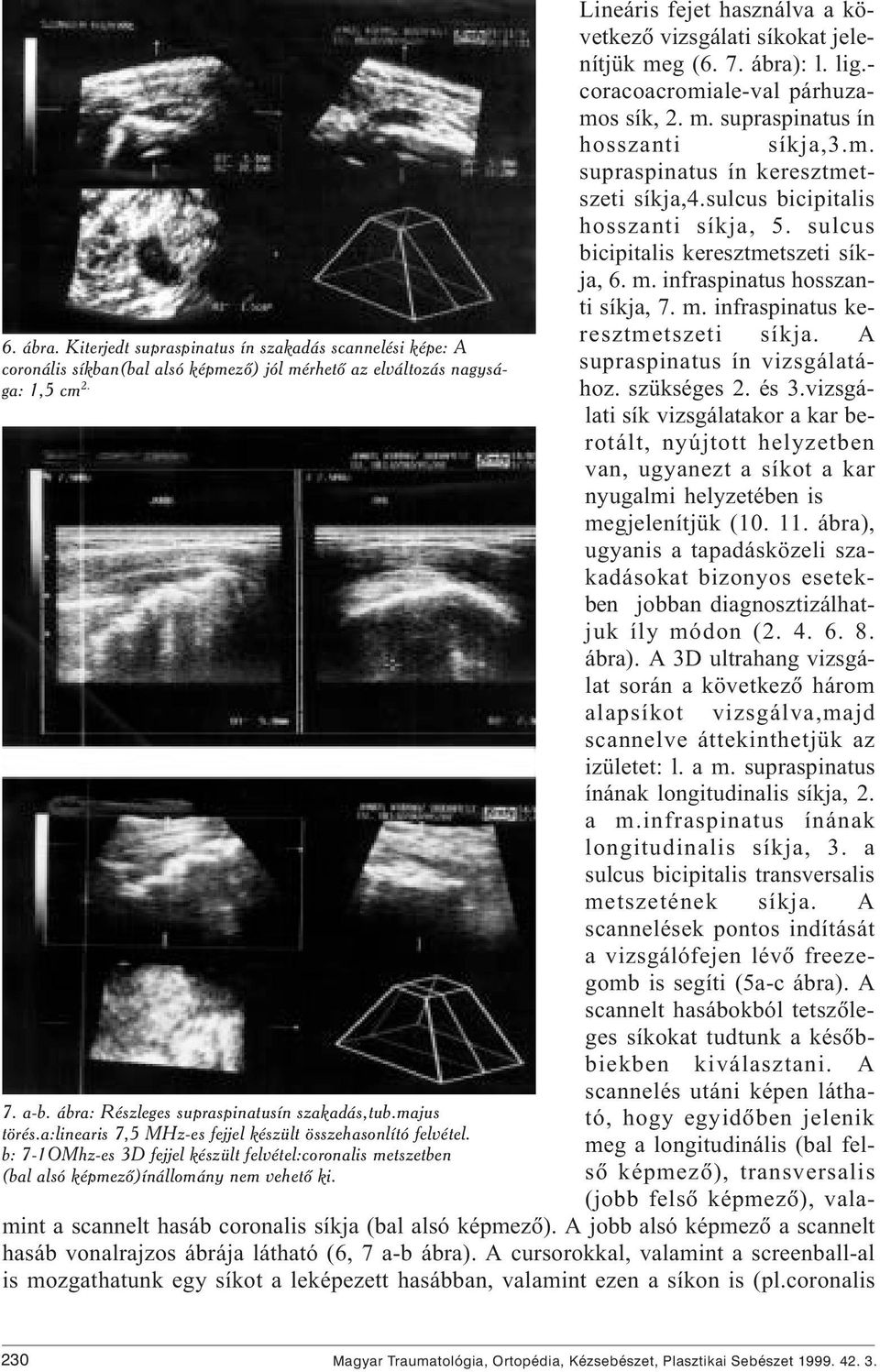 Lineáris fejet használva a következõ vizsgálati síkokat jelenítjük meg (6. 7. ábra): l. lig.- coracoacromiale-val párhuzamos sík, 2. m. supraspinatus ín hosszanti síkja,3.m. supraspinatus ín keresztmetszeti síkja,4.