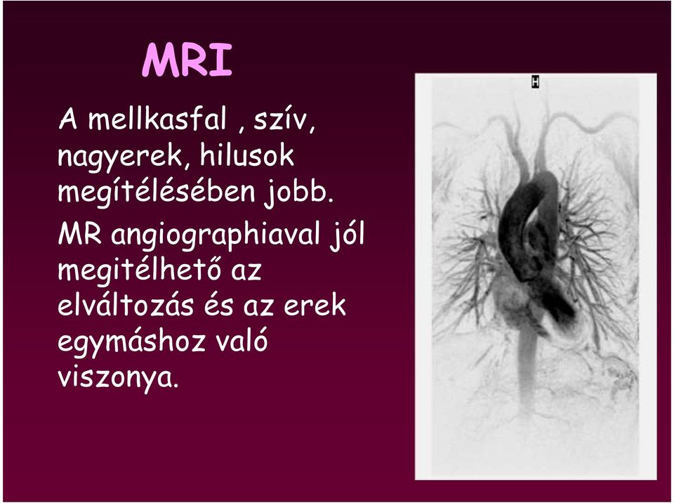 MR angiographiaval jól megitélhetı