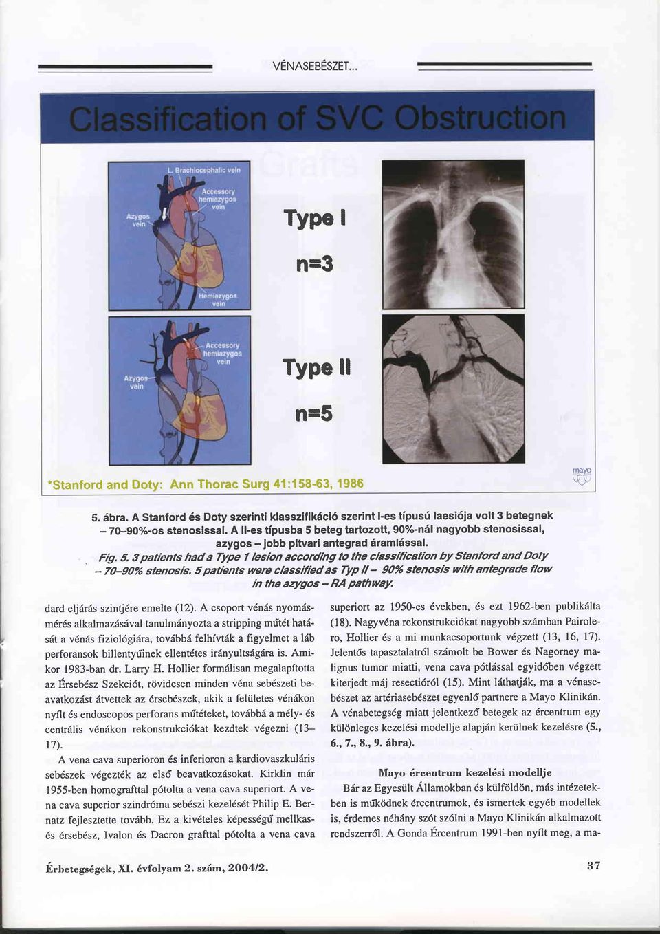 A lfes tipusba 5 beteg tartozott, 90%-näl nagyobb stenosissal, azygos - jobb pitvari antegrad äramlässal. Ftg. 5. 3 patients had a Type f lesion accordng to the classificatrbn by Stanford and Doty - 70-90% stenosis.