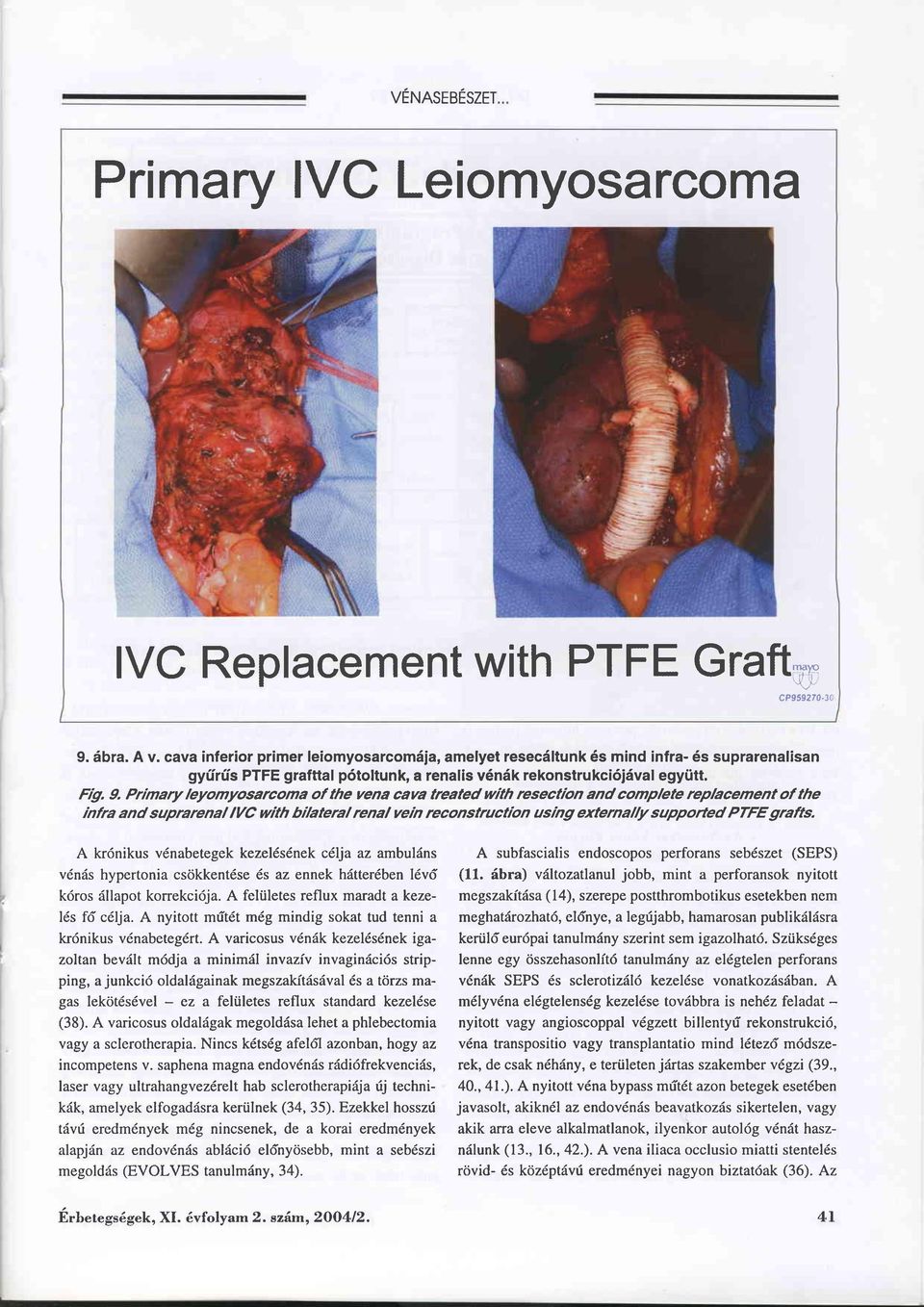 Primary leyomyosarcoma ol the yena caua treated with resectrbn and complete replacement ol the rnfra and suprarenal IVC with bilateral renal vein reconstructrbn usng externally supported PTFE grafts.