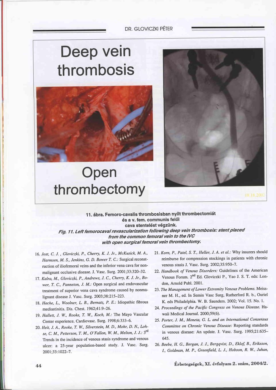 , Cherry, K. J. Jr', McKusick, M' A', Harmsen, M.5., Jenkins, G. D. Bower T. C.: Surgical reconstruction of iliofemoral veins and the inferior vena cava for nonmalignant occlusive disease. J. Vasc.
