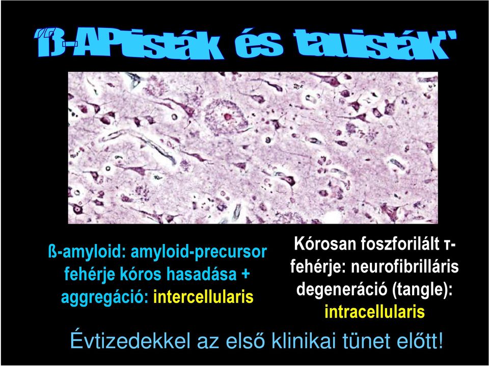 τ- fehérje: neurofibrilláris degeneráció (tangle):