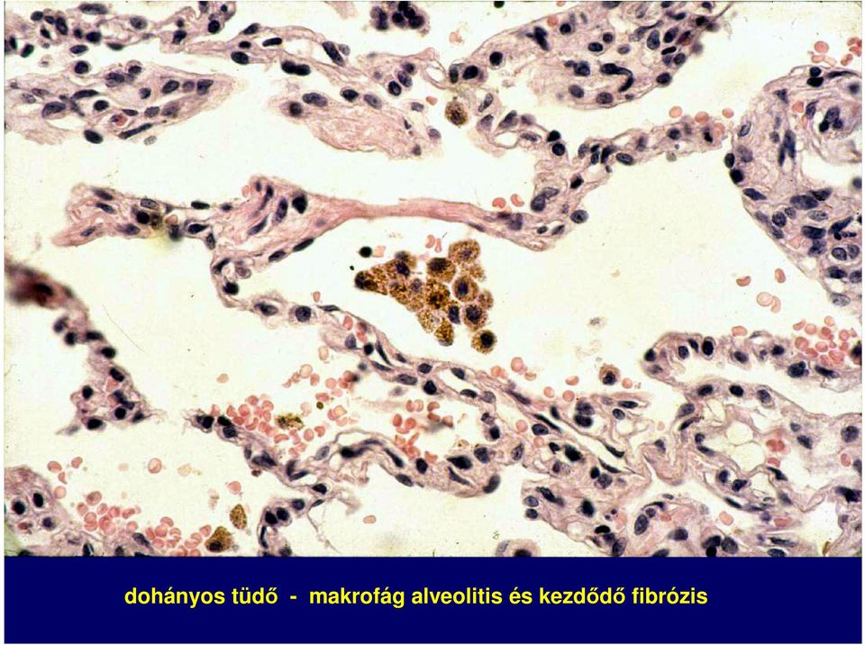 alveolitis és